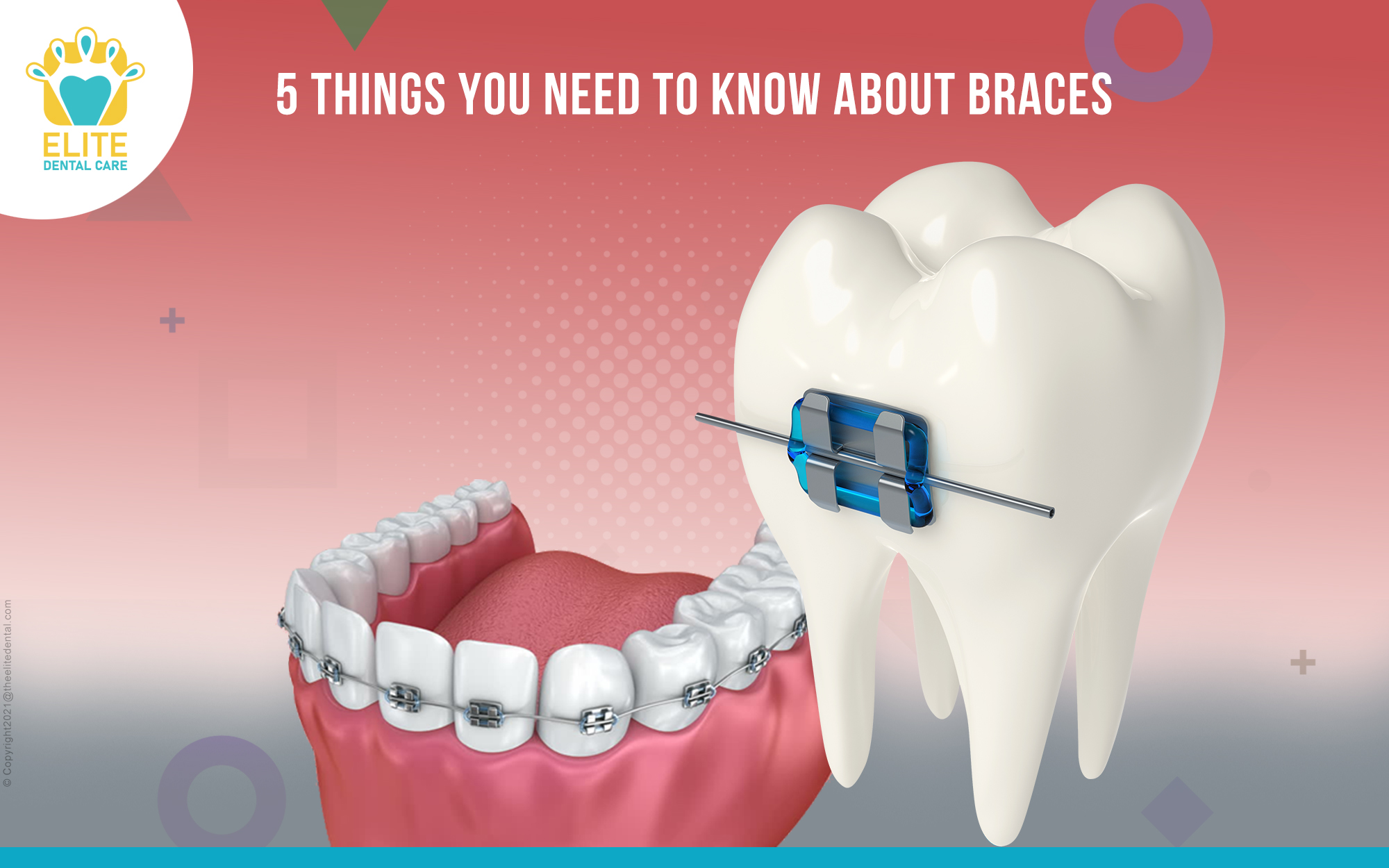 5 Things you need to know about braces Elite Dental Care