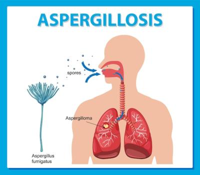 Vector Template: Aspergillus Infection Diagram