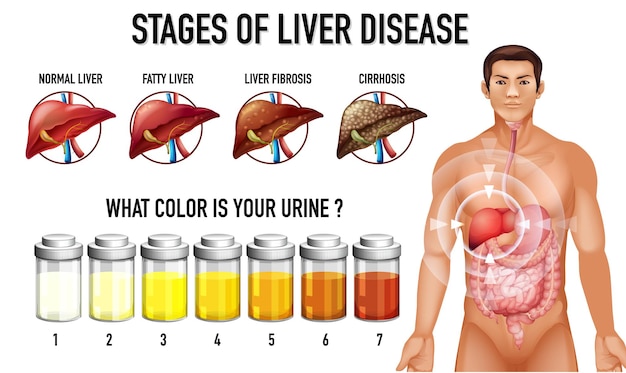 Stages of Liver Disease Vector Templates for Free Download