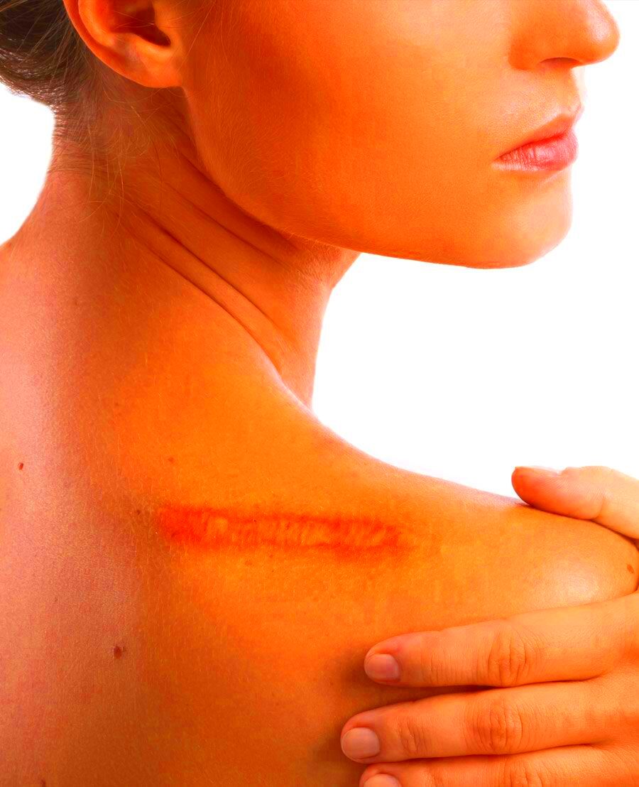 Scars Keloid Scarring Scar Management Face Restoration Facial 