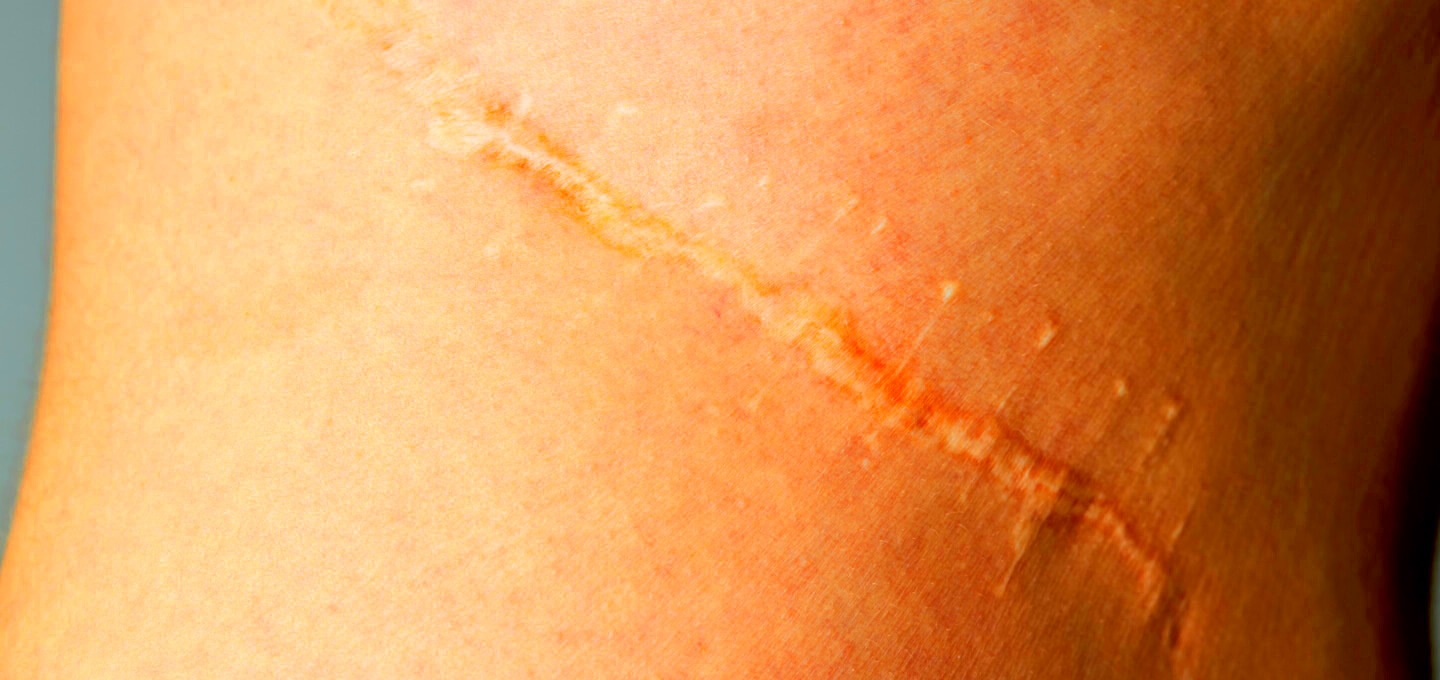 Scars Dermatology and Skin Health Dr Mendese