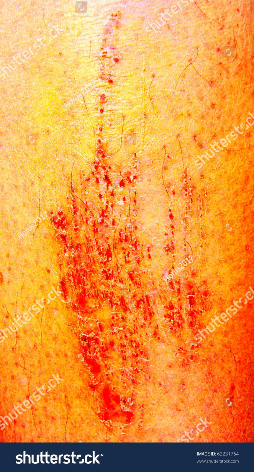 Scar Stock Photo 62231764 Shutterstock