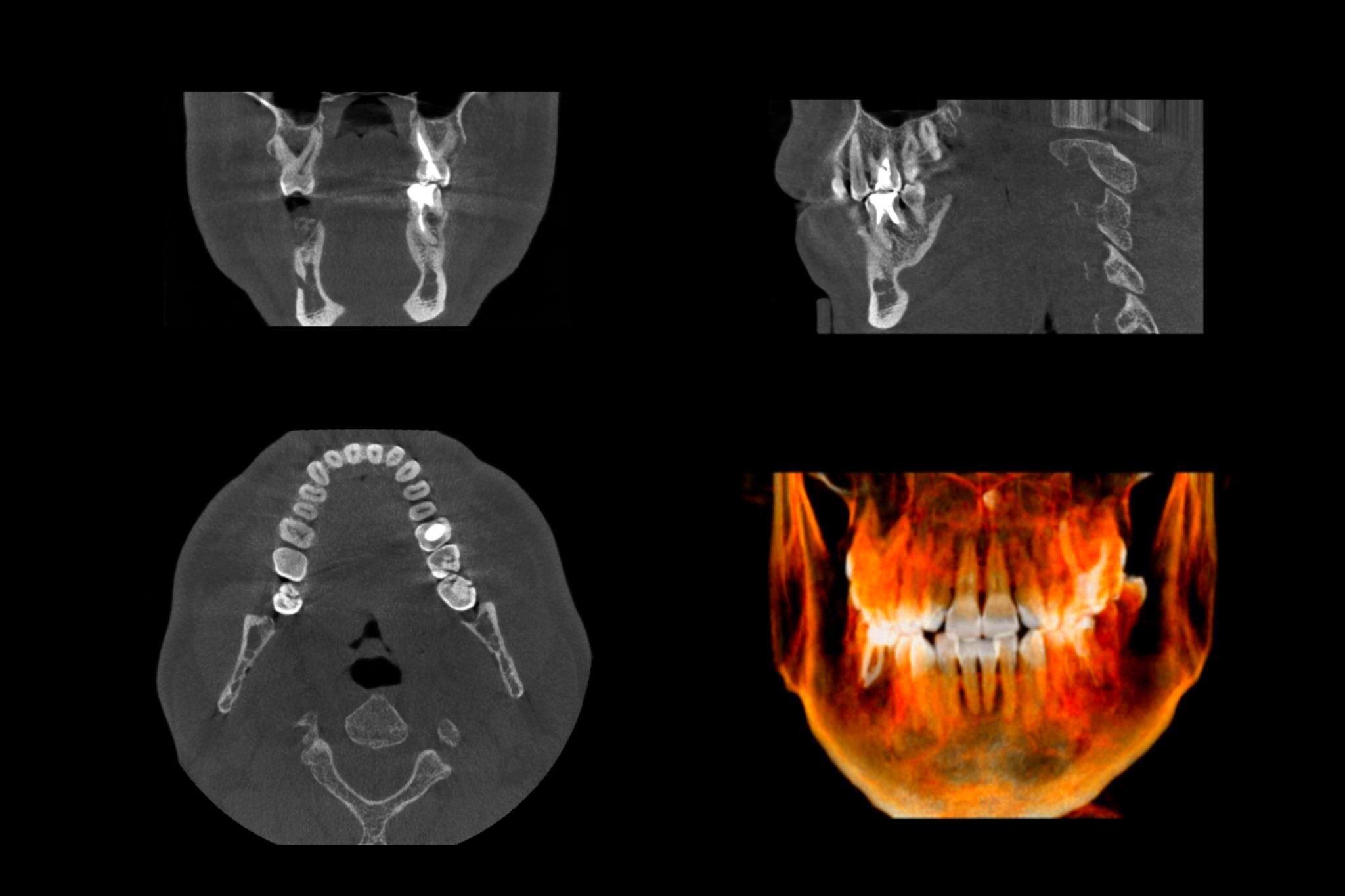 3D Imaging CBCT Compassion Endodontics