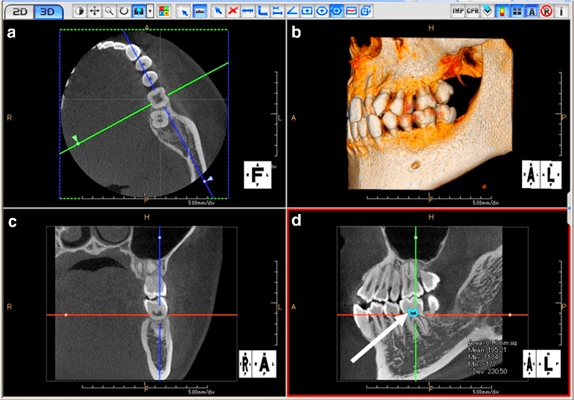 CBCT Imaging Beyond Dental XRays ITS Dental Hospital