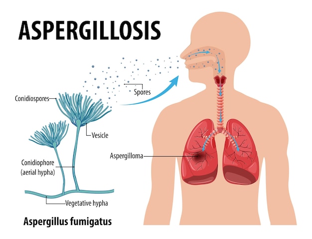 Aspergillus Infection Diagram – Free Download