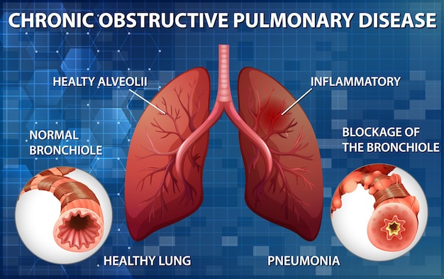 Lung Health Illustration for Chronic Obstructive Pulmonary Disease – Free Download