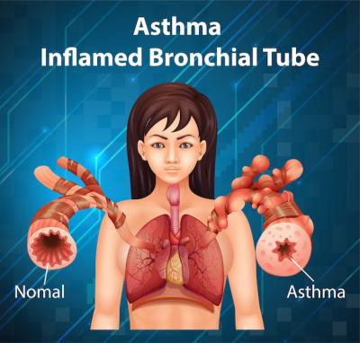 Asthma Inflamed Bronchial Tube Diagram – Free Download