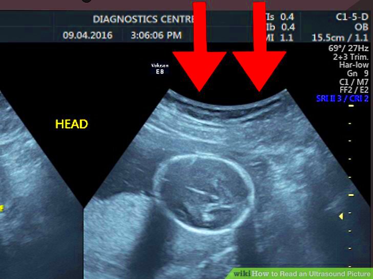 How to Read an Ultrasound Picture 9 Steps with Pictures