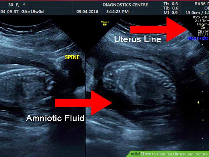 How to Read an Ultrasound Picture 9 Steps with Pictures