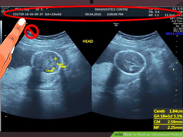 How to Read an Ultrasound Picture 9 Steps with Pictures