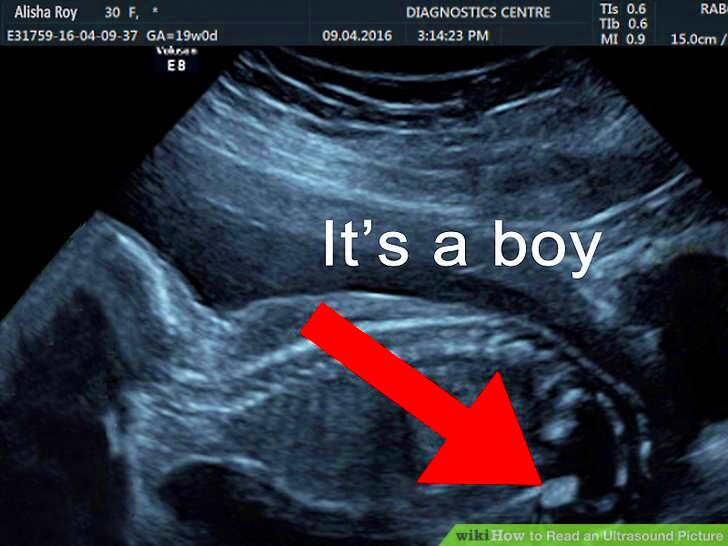 How to Read an Ultrasound Picture 9 Steps with Pictures