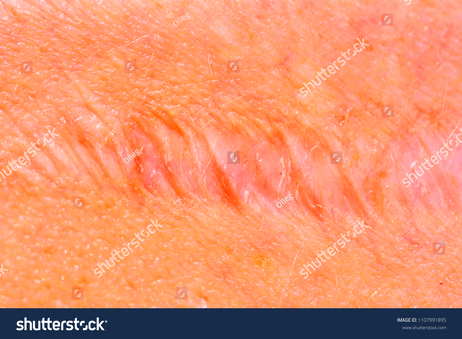 Scar On Skin Human Scar Closeup Stock Photo 1107991895  Shutterstock