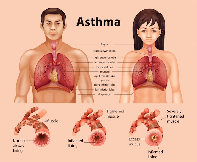 Healthy Lung vs. Asthmatic Lung: Free Stock Photos Download