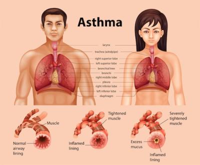 Healthy Lung vs. Asthmatic Lung: Free Stock Photos Download