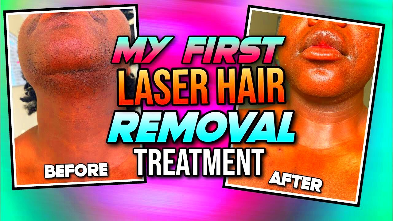 My First Laser Hair Removal Treatment  Ideal Image Review Laser Hair 