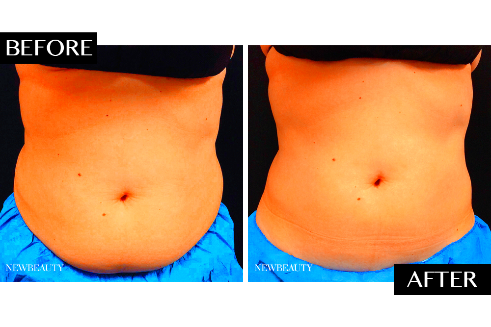 CoolSculpting Ideal Image Stomach Review  NewBeauty