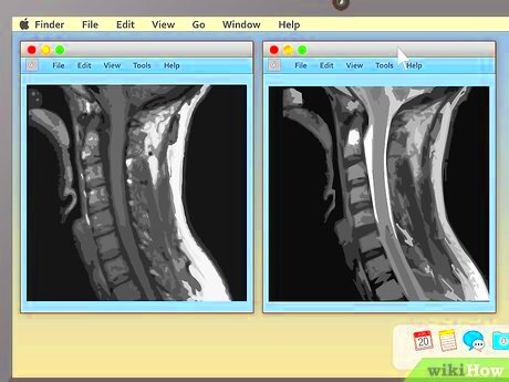 How to Read an MRI 15 Steps with Pictures  wikiHow