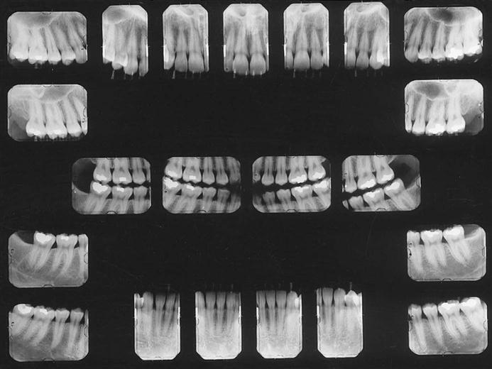 7 Intraoral Projections  Pocket Dentistry