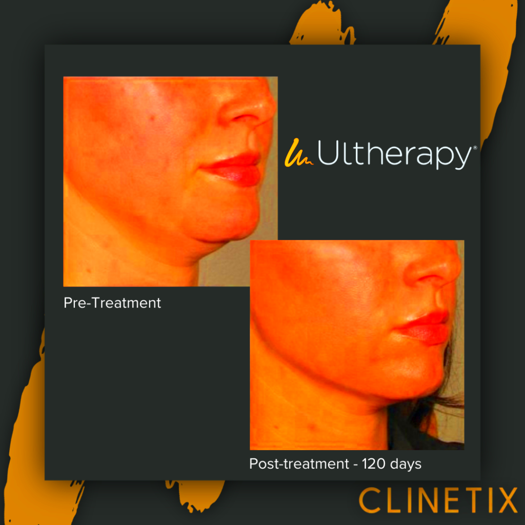 What does Ultherapy do And our Special Offer in Inverurie