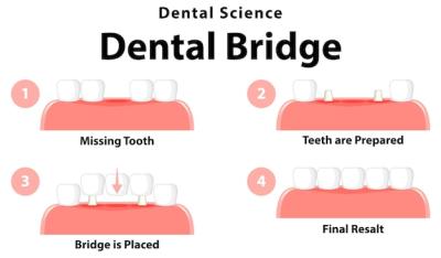 Infographic of Human in Dental Bridge on White Background – Free Stock Photo, Download Free