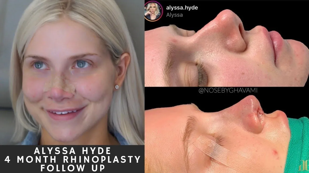 4 Months post VERY Complex Primary Rhinoplasty with 