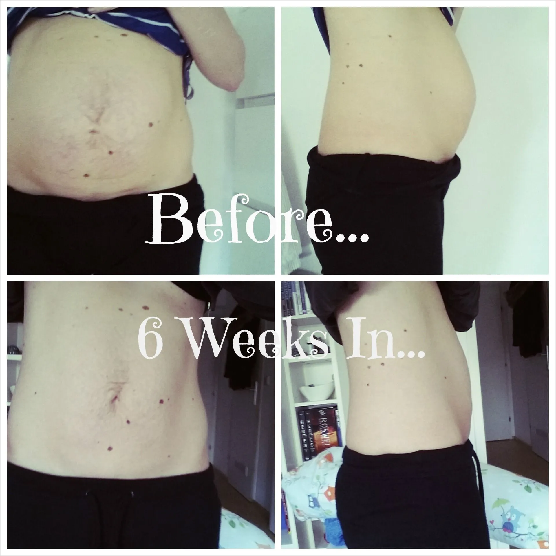 How To Fix Diastasis Recti Years Later Uk  IRUCNE