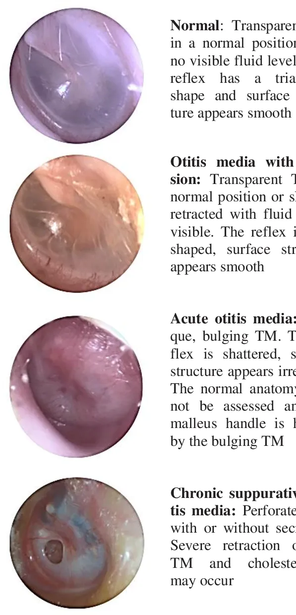 Normal Tympanic Membrane Vs Bulging