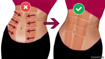 How to Fix Diastasis Recti Years Later with YouTube Tips and Techniques