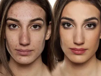 How to Cover Pimples with Makeup for Flawless Skin