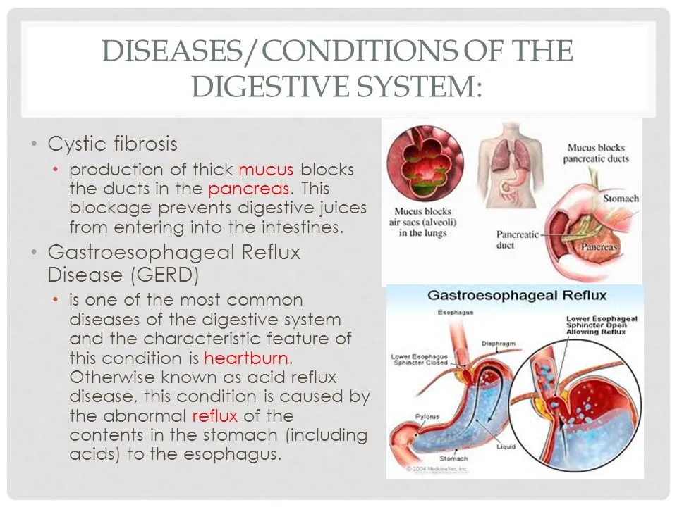 Digestive System Common Diseases