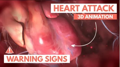 Understanding How Heart Attacks Occur with a Dailymotion Video Explanation