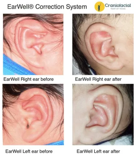 Understanding the Rarity of Ear Rumbling and Its Health Implications