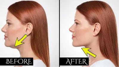 Eliminate Double Chin in Just Two Days with Dailymotion Tips