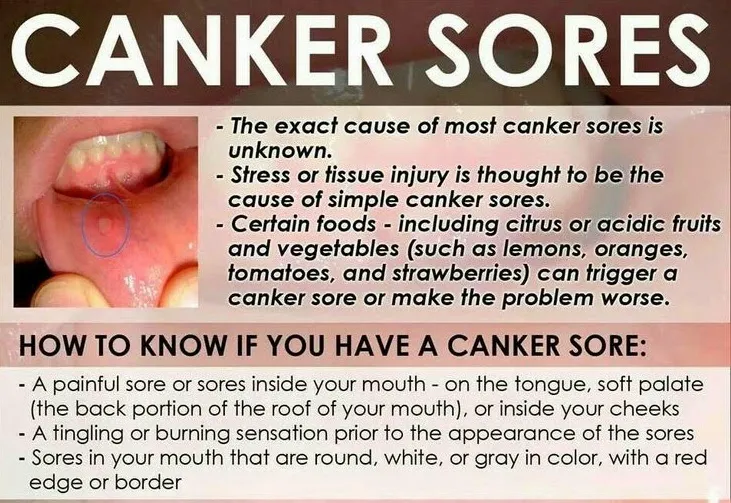 Quick treatment for canker sores