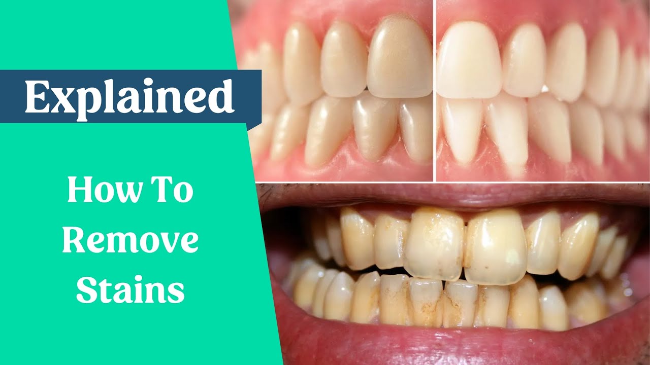 How to Clean Yellow Teeth at Home with Effective Tips and Techniques