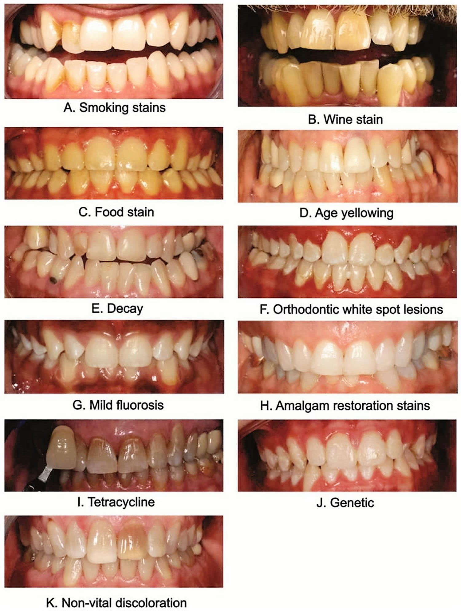 How to Whiten Teeth Naturally  Home Treatment Vs Professional Therapy