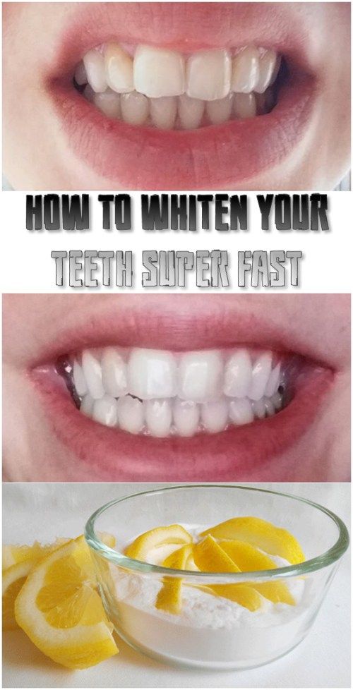 Quick and Effective Tips to Whiten Teeth in 2 Minutes