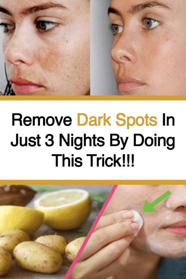 Effective Home Remedies for Eliminating Black Spots on Your Face