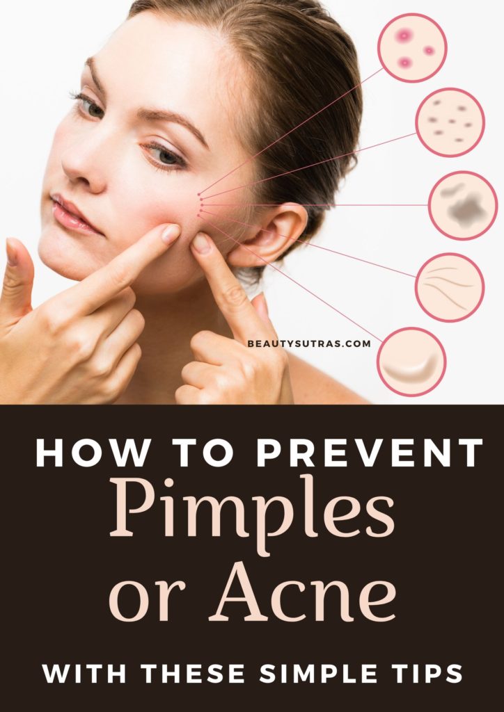 How to Prevent Pimples or Acne Tips and Home Remedies  BeautySutras