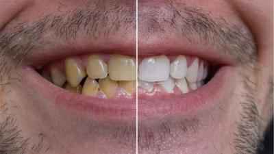 How to Clean Yellow Teeth at Home with Effective Tips and Techniques