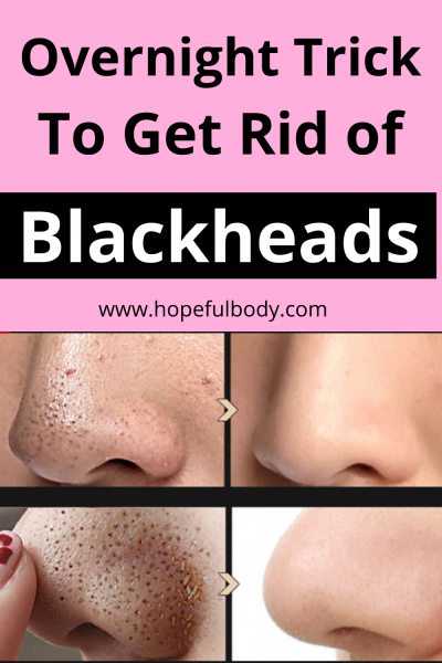Proven Ways to Eliminate Blackheads from Your Face at Home