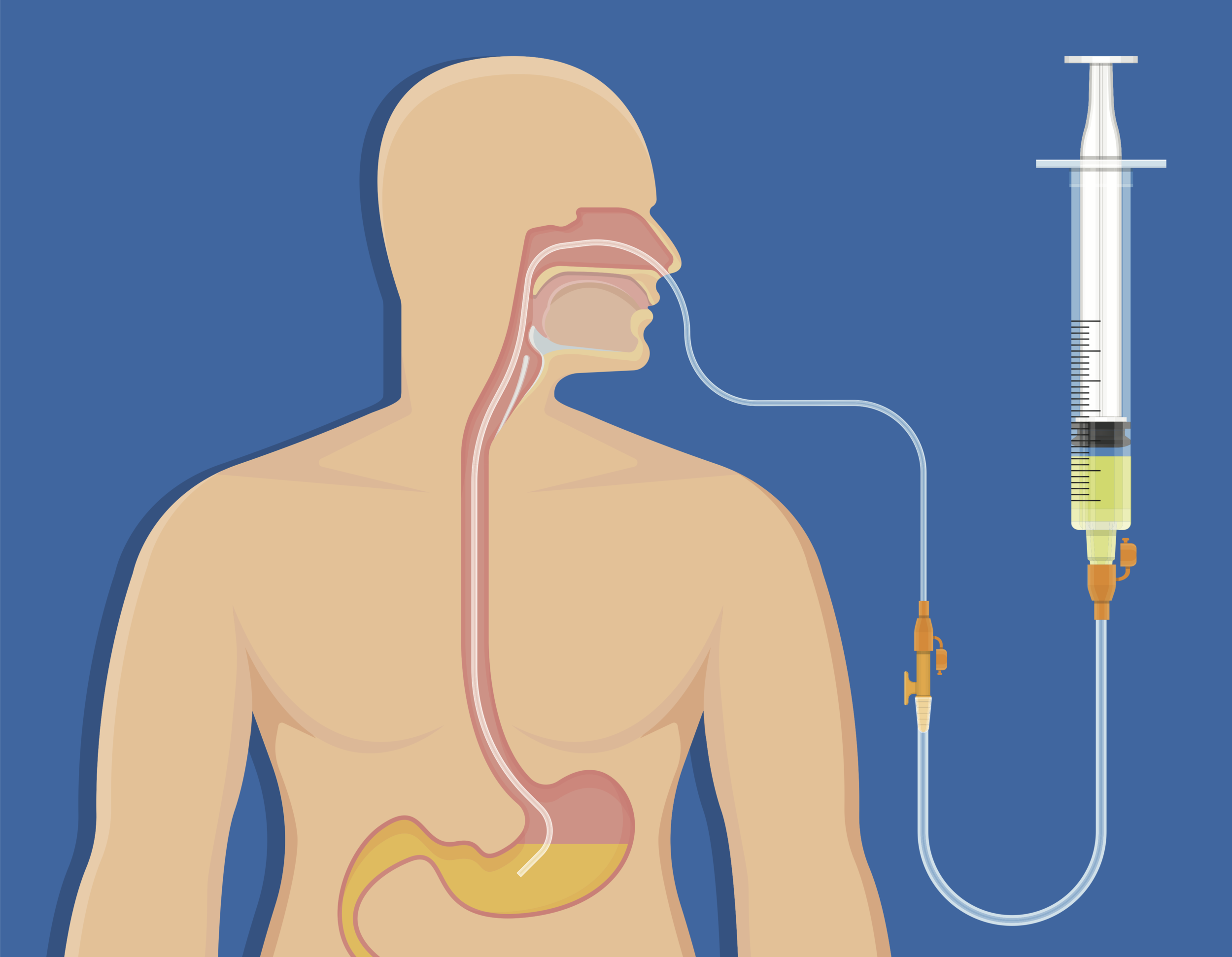 Nasogastric Intubation Nasogastric Tube Tube Stock Vector By Sakurra 