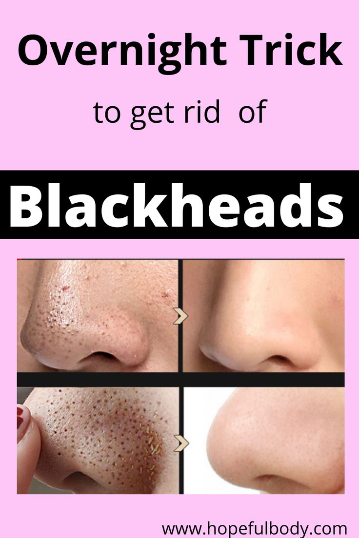 Effective Home Remedies to Remove Blackheads from Your Nose