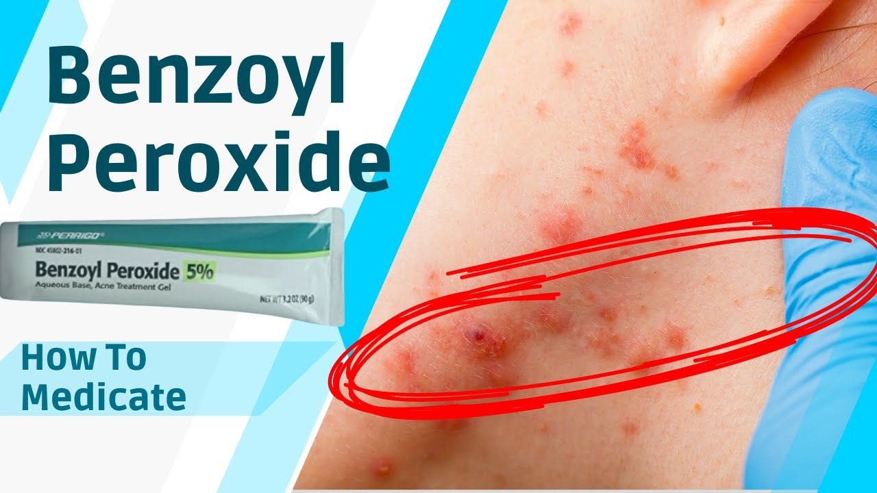 How to use Benzoyl Peroxide to CLEAR ACNE   Dermatologist Explains 