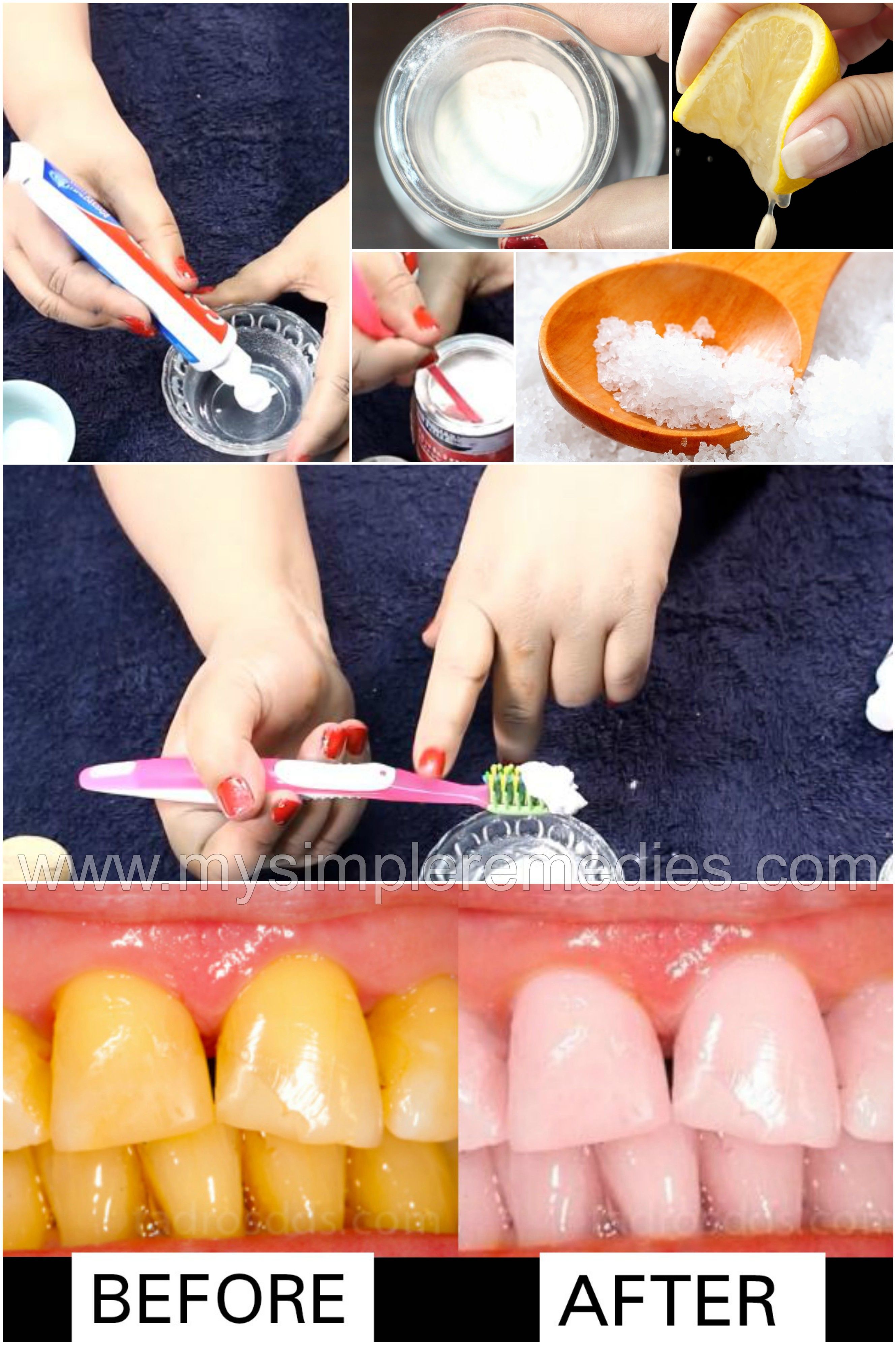 How to Whiten My Teeth at Home with Dailymotion Tips and Tricks