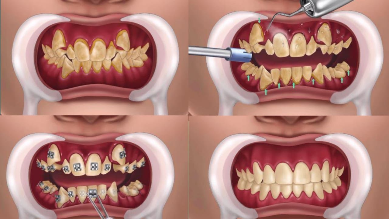 Master the Art of Applying Braces on Teeth with Dailymotion Videos