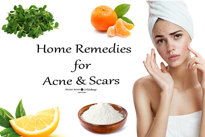 Effective Home Remedies for Removing Acne Scars