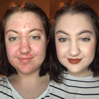 Effective Techniques for Covering Acne with Makeup