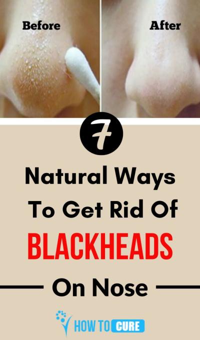 Effective Home Remedies to Remove Blackheads from Your Nose