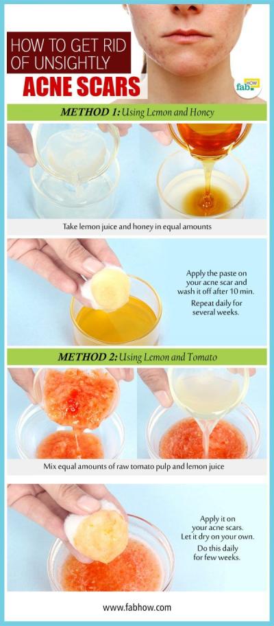 Effective Home Remedies for Removing Acne Scars